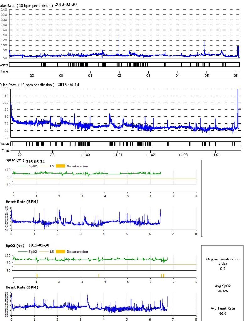 Are pulse spikes like this generally normal at night?